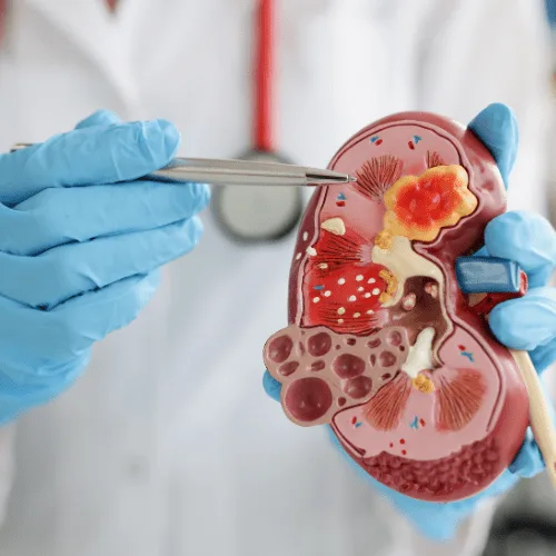 ¿Por qué se presenta la hematuria y cómo tratarla en Campeche?